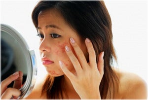 getty rf photo of asian woman with acne
