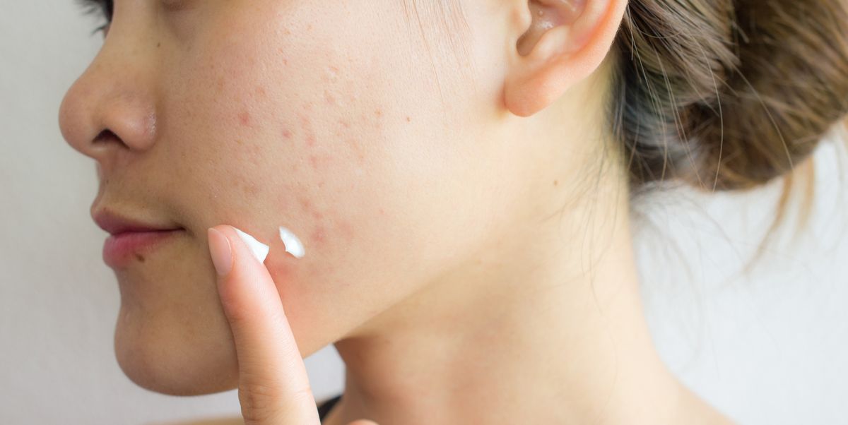 portrait of young asian woman having acne problem royalty free image 1061188712 1563715891