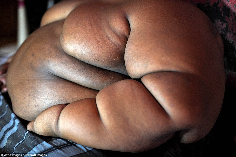 Obese 10-Year Old Boy Weights As Much As An Adult Male Lion - World Of Buzz 6