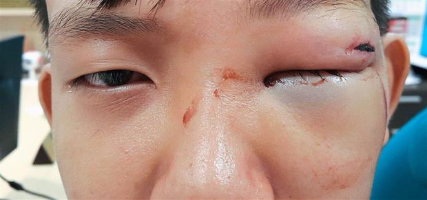 Boy Narrowly Escapes Blindness After Freak Accident Lodges Chopstick In Eye Cavity - World Of Buzz 1