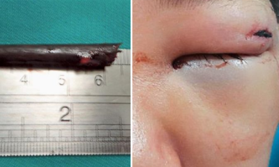 Boy Narrowly Escapes Blindness After Freak Accident Lodges Chopstick In Eye Cavity - World Of Buzz 2