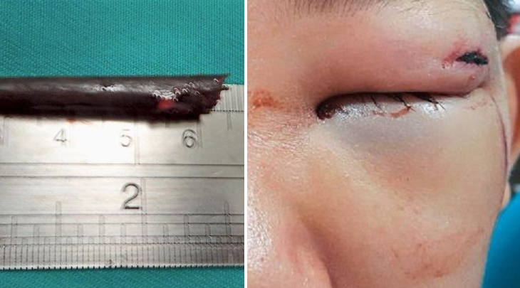 Boy Narrowly Escapes Blindness After Freak Accident Lodges Chopstick In Eye Cavity - World Of Buzz 2