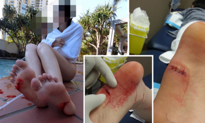 Happy Trip To Hotel Pool Ends In Horror As Girl'S Leg Was Gruesomely Cut - World Of Buzz 7