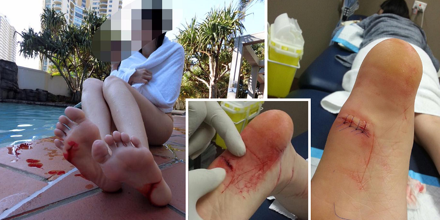 Happy Trip To Hotel Pool Ends In Horror As Girl'S Leg Was Gruesomely Cut - World Of Buzz 7