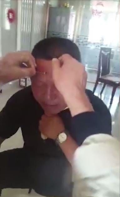 'Doctor' Punctures Hole In Man's Forehead As Treatment For Headaches - World Of Buzz 2