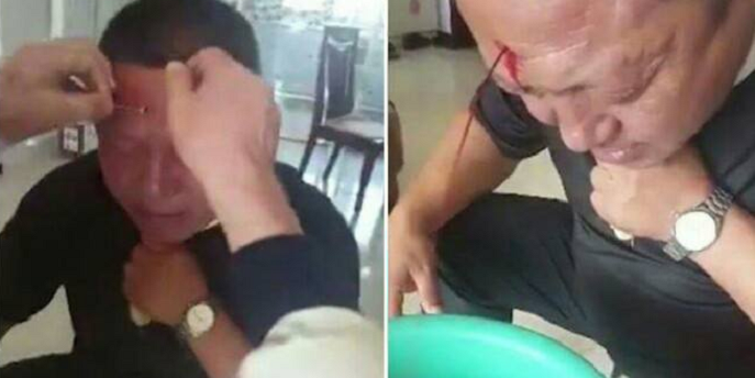 'Doctor' Punctures Hole In Man'S Forehead As Treatment For Headaches - World Of Buzz 5