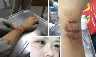 Malaysian Girl Shares Terrifying Moment Ruthless Snatch Thieves Slashed Her Arm - World Of Buzz