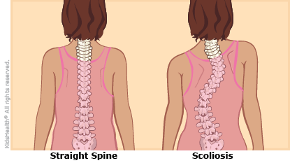 Scoliosis-1