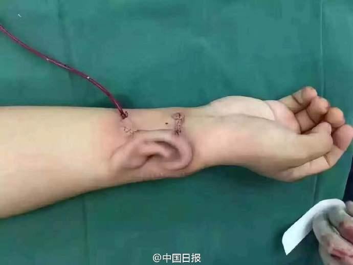 Guy Loses Right Ear In Accident, Doctors Grow Another On His Arm! - World Of Buzz 1