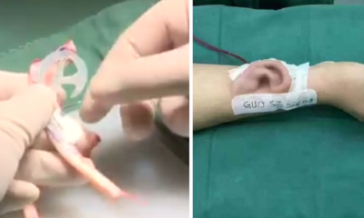 Guy Loses Right Ear In Accident, Doctors Grow Another On His Arm! - World Of Buzz 5