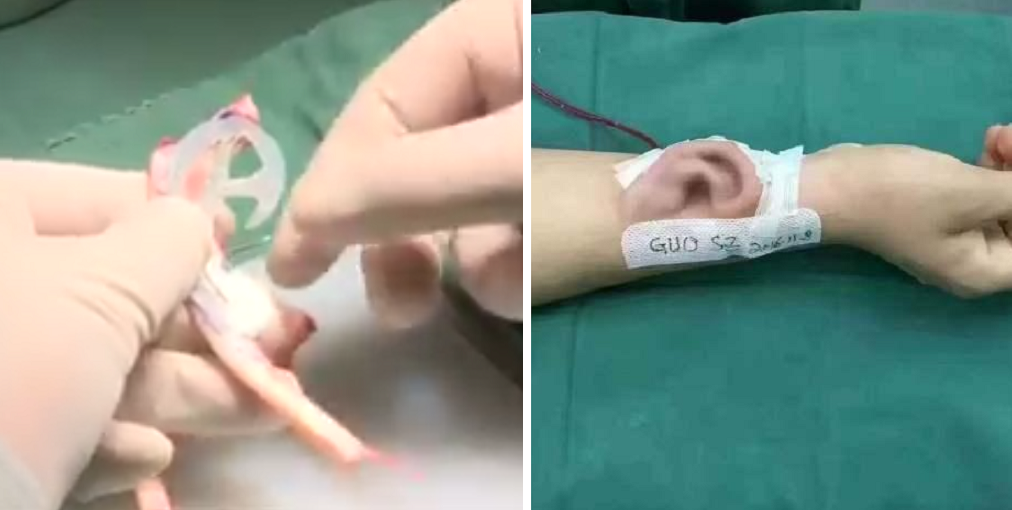 Guy Loses Right Ear In Accident, Doctors Grow Another On His Arm! - World Of Buzz 5