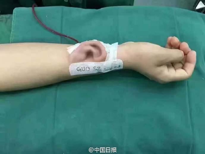 Guy Loses Right Ear In Accident, Doctors Grow Another On His Arm! - World Of Buzz