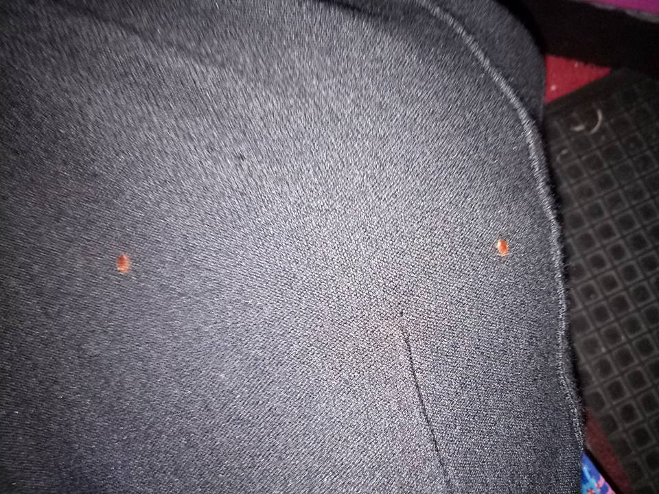 26 Passengers Horrifyingly Bitten By Bed Bugs On Express Bus From Kl To Singapore - World Of Buzz