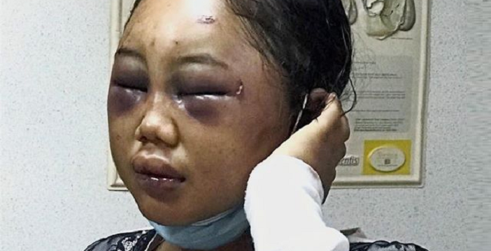 Indonesian Maid Brutally Abused By Malaysian Employer - World Of Buzz 3