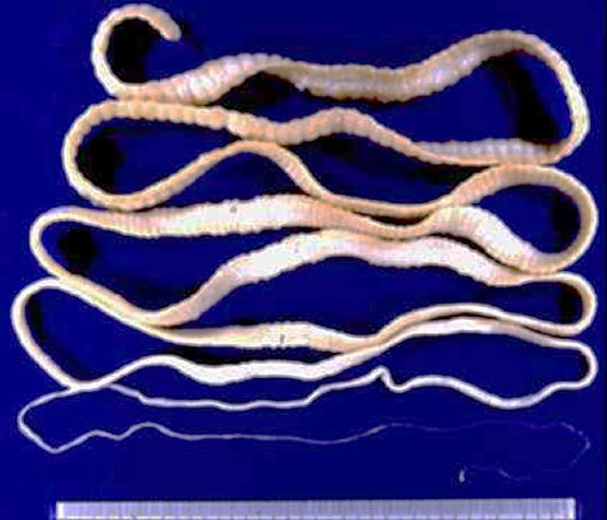 1.88m Long Tapeworm Pulled Out From Guy's Stomach - World Of Buzz 1