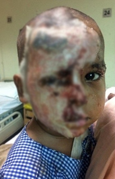 Innocent 2 Yo Boy's Face Splashed With Acid, After His Mother Rejects A Man's Love - World Of Buzz 2