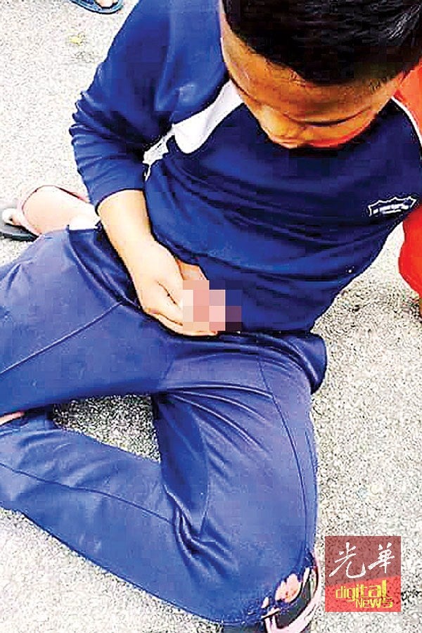 Malaysian Boy's Small Intestines Exposed After Stomach Penetrated By Bicycle Handle - World Of Buzz