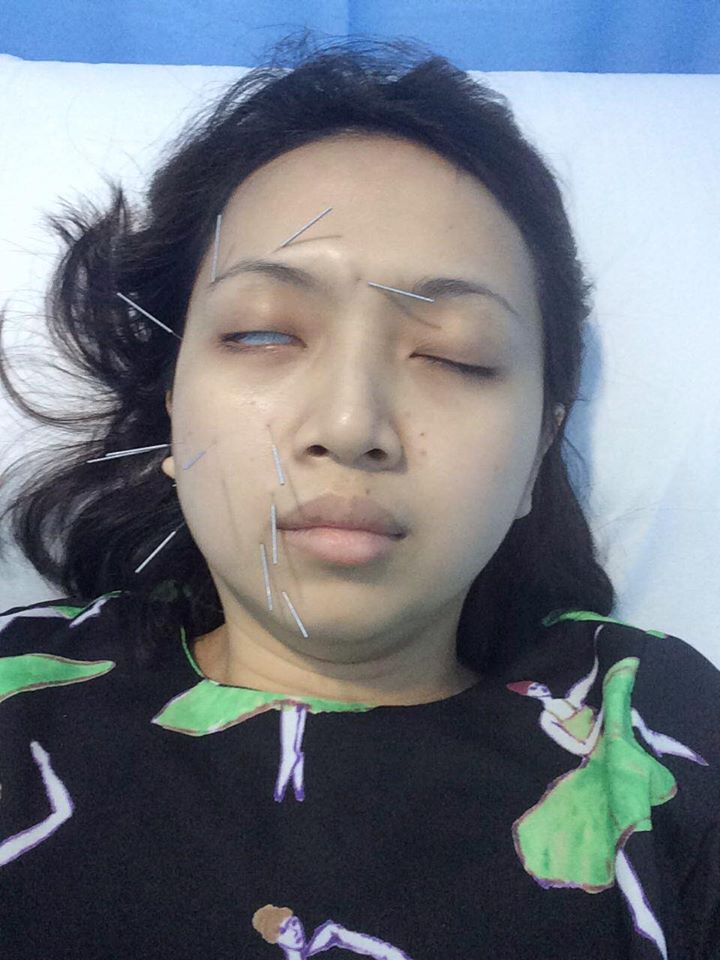 Malaysian Woman Shares The Surprising Story Of Why Her Face Was Drooping On Side - World Of Buzz 4