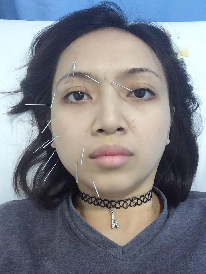 Malaysian Woman Shares The Surprising Story Of Why Her Face Was Drooping On Side - World Of Buzz 6