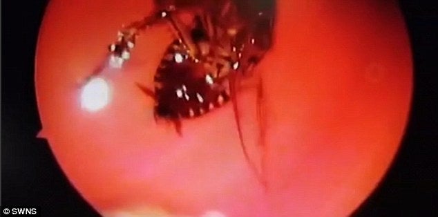 Doctors Remove Live Cockroach from Indian Woman's Head After 12 Hours - World Of Buzz 1