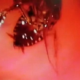 Doctors Remove Live Cockroach From Indian Woman'S Skull - World Of Buzz