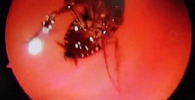 Doctors Remove Live Cockroach From Indian Woman'S Skull - World Of Buzz