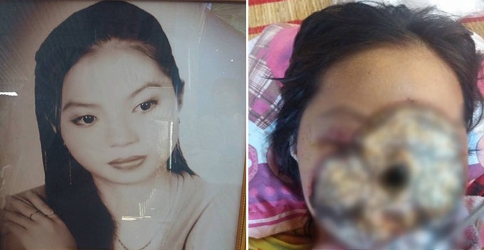 Vietnamese Girl's Face 'Eaten' By Bacteria Due To Sinus Infection - World Of Buzz