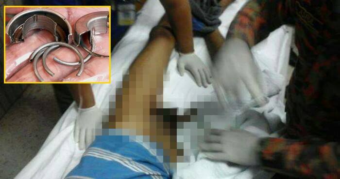 Malaysian Man Suffered 12 Hours Of Pain After Penis Ring Could Not Come Off - World Of Buzz 4