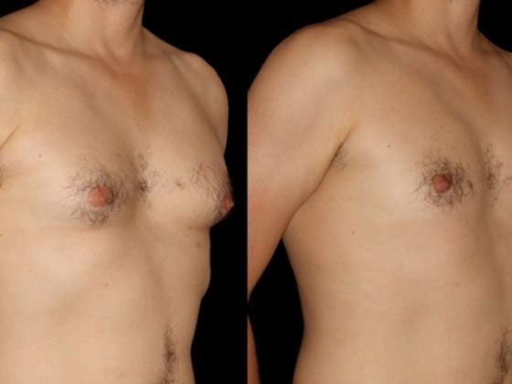 Singaporean Man Gets Breast Reduction Surgery After Failing To Reduce Fat - World Of Buzz 1
