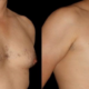 Singaporean Man Gets Breast Reduction Surgery After Failing To Reduce Fat - World Of Buzz 5