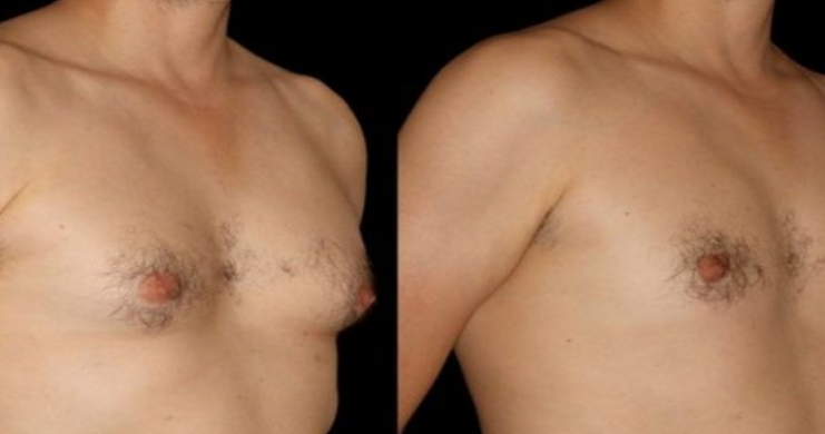 Singaporean Man Gets Breast Reduction Surgery After Failing To Reduce Fat - World Of Buzz 5