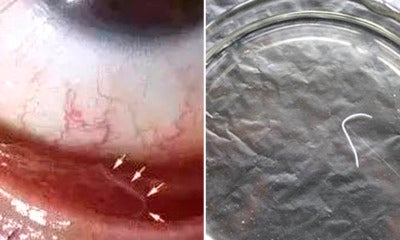 Chinese Lady Loves Cuddling With Pet Dog Discovers 2Cm Worm Inside Her Eye - World Of Buzz