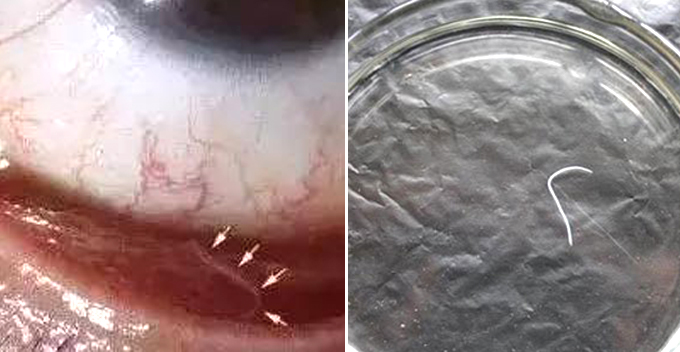 Chinese Lady Loves Cuddling With Pet Dog Discovers 2Cm Worm Inside Her Eye - World Of Buzz