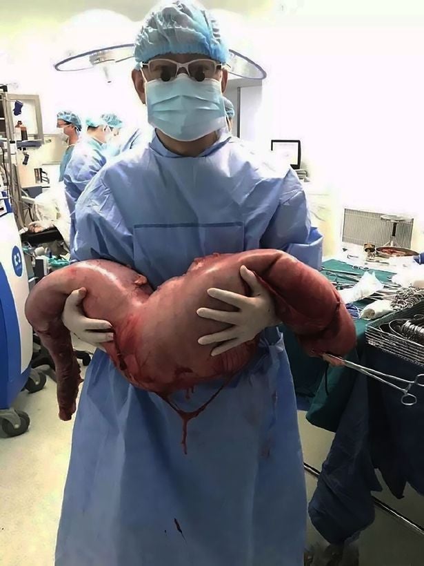 Chinese Surgeons Remove 76 centimetres of Man's Intestines to Relieve Constipation - World Of Buzz 4