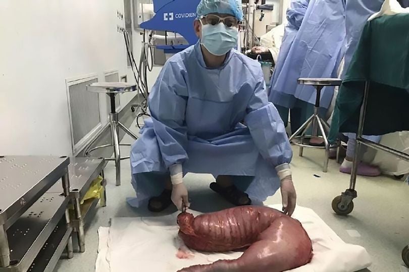 Chinese Surgeons Remove 76 centimetres of Man's Intestines to Relieve Constipation - World Of Buzz 5