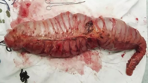 Chinese Surgeons Remove 76 centimetres of Man's Intestines to Relieve Constipation - World Of Buzz 6