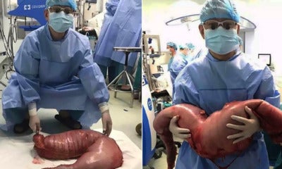 Chinese Surgeons Remove 76 Centimetres Of Man'S Intestines To Relieve Constipation - World Of Buzz 7
