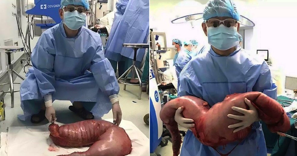 Chinese Surgeons Remove 76 Centimetres Of Man'S Intestines To Relieve Constipation - World Of Buzz 7