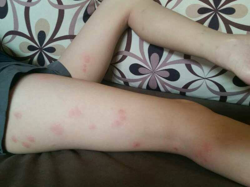 Girl Experiences Terrible Bed Bug Bites In Express Bus From Thailand To Kl - World Of Buzz 2
