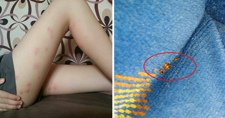 Girl Experiences Terrible Bed Bug Bites In Express Bus From Thailand To Kl - World Of Buzz 3