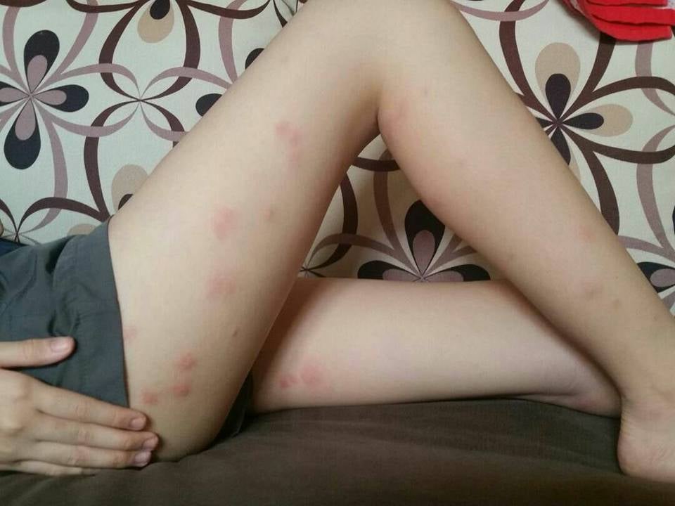 Girl Experiences Terrible Bed Bug Bites In Express Bus From Thailand To Kl - World Of Buzz