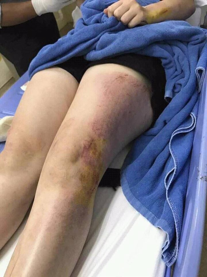 Siblings Suffer Horrible Injuries While Having Family Day Out At Melaka Resort - World Of Buzz 3