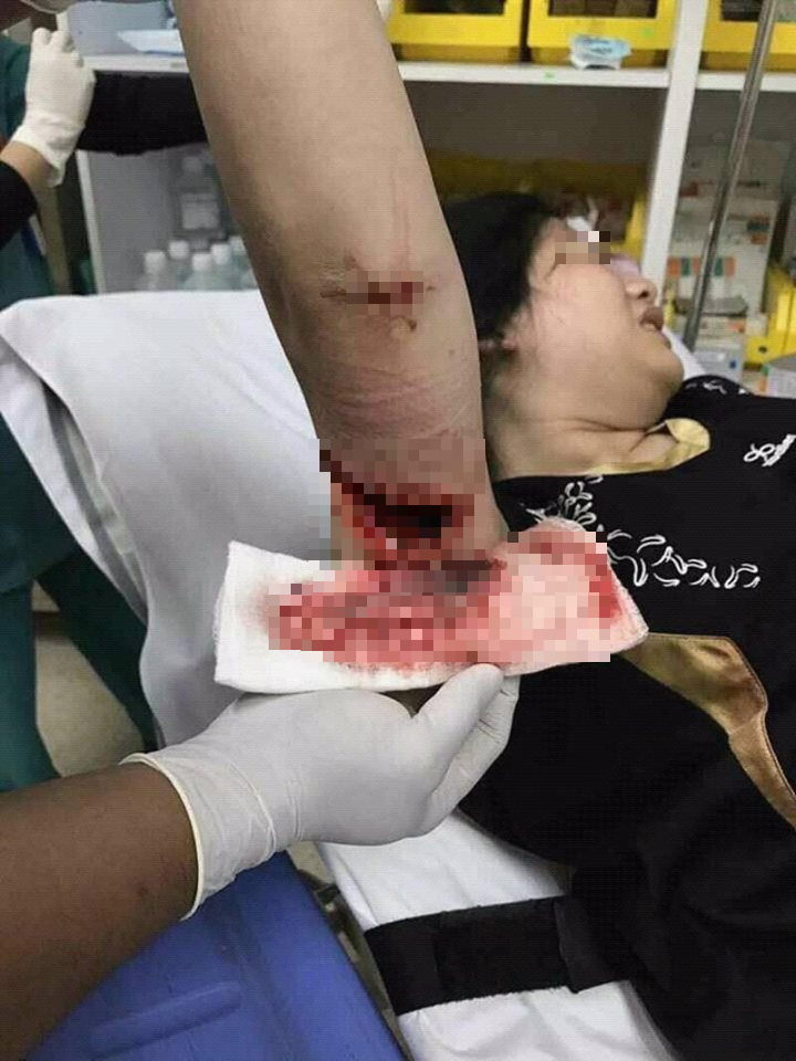Siblings Suffer Horrible Injuries While Having Family Day Out At Melaka Resort - World Of Buzz