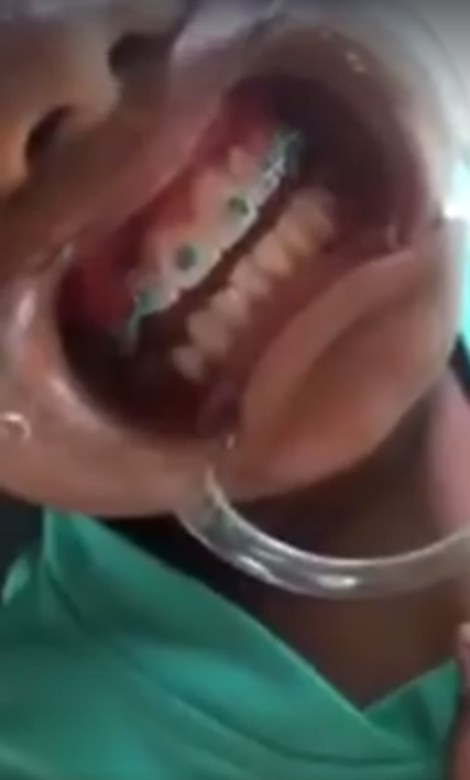 Video of Thai Schoolboy Installing Braces on his Schoolmates Goes Viral - World Of Buzz 1