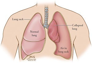 Lung 1