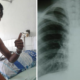 Indonesian Man Suffers Collapsed Lung Due To Smoking, Netizens Vow To Quit - World Of Buzz