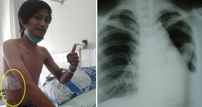 Indonesian Man Suffers Collapsed Lung Due to Smoking, Netizens Vow to Quit - World Of Buzz