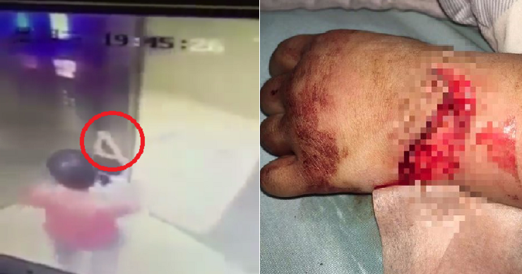 Little Girl Plays in Elevator, Suffers Serious Injuries After Hands Slipped into Cracks - World Of Buzz 3