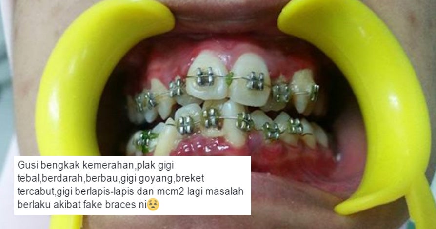 malaysian dentist shocked to find his patient wearing fake braces world of buzz