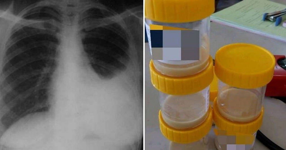24Yo Malaysian Smoker Dies After Doctor Finds Nearly 1 Litre Of Pus In Lung - World Of Buzz